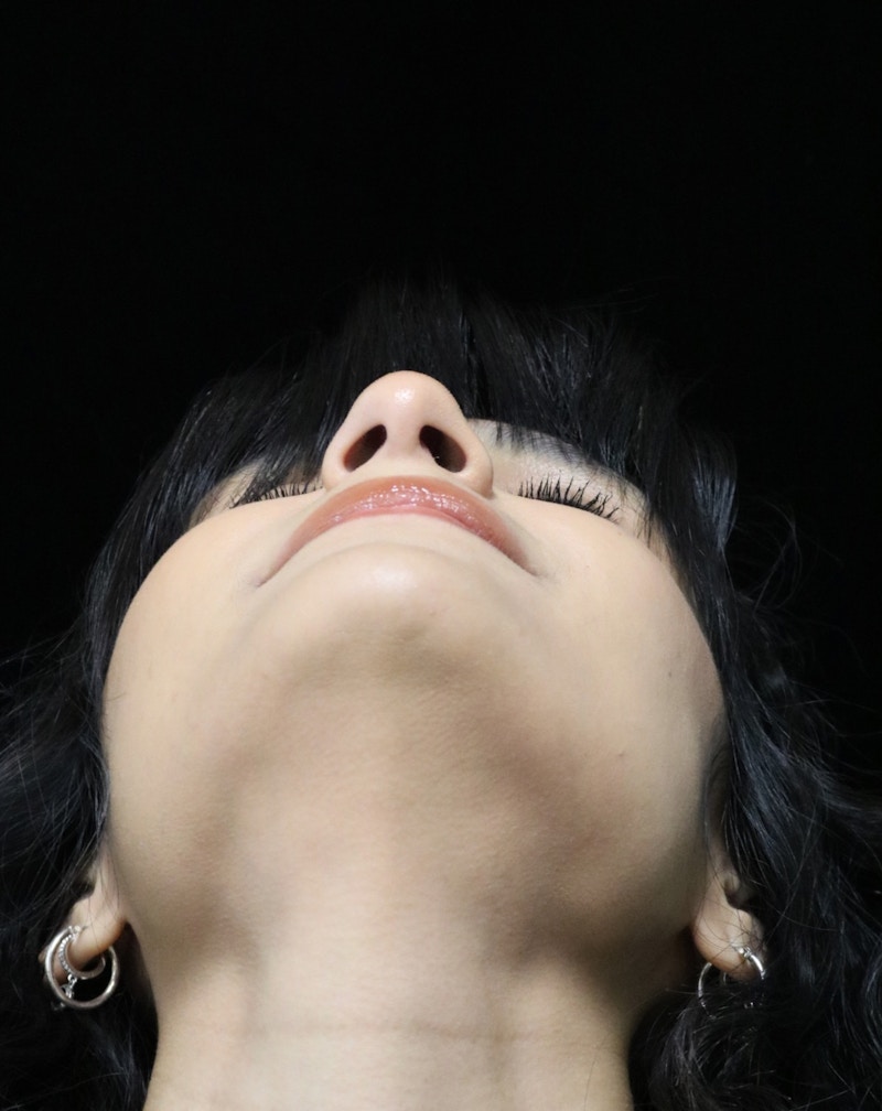 Beverly Hills Rhinoplasty Before & After Gallery - Patient 428554 - Image 13 Dr. Deepak Raj Dugar