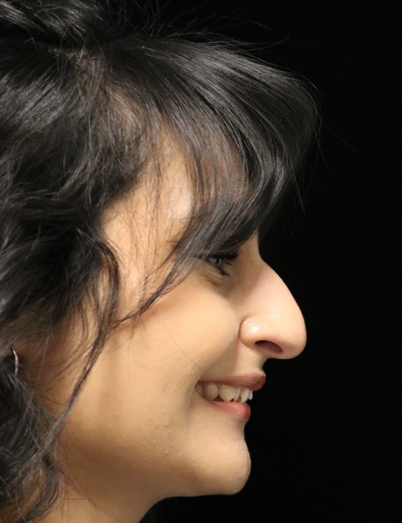 Beverly Hills Rhinoplasty Before & After Gallery - Patient 428554 - Image 3 Dr. Deepak Raj Dugar