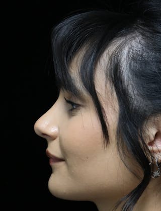 Beverly Hills Rhinoplasty Before & After Gallery - Patient 428554 - Image 12 Dr. Deepak Raj Dugar