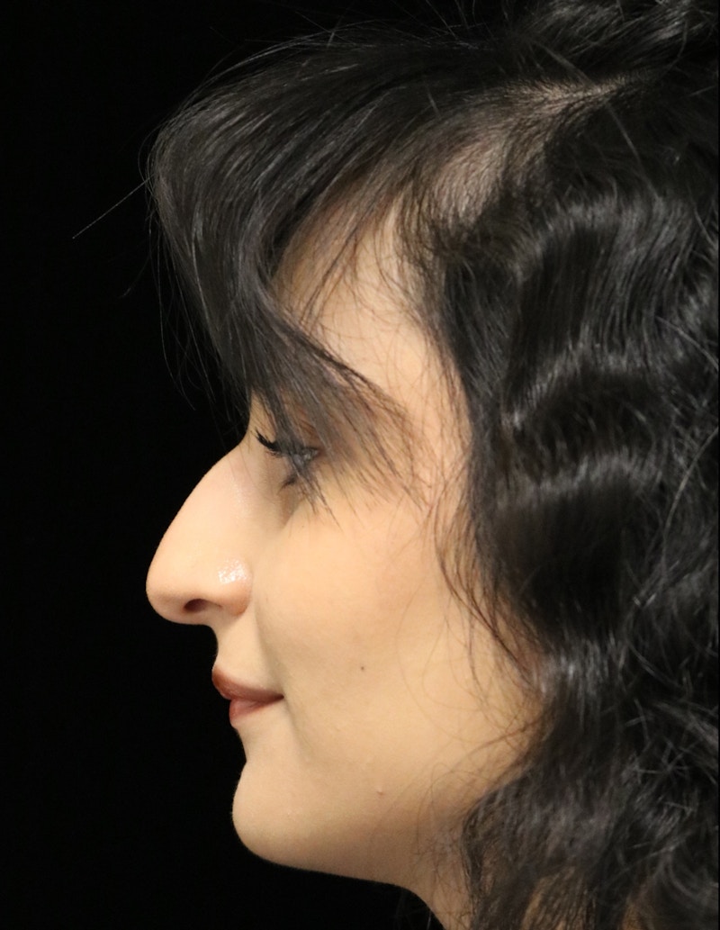 Beverly Hills Rhinoplasty Before & After Gallery - Patient 428554 - Image 11 Dr. Deepak Raj Dugar