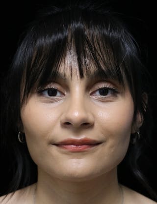 Beverly Hills Rhinoplasty Before & After Gallery - Patient 428554 - Image 6 Dr. Deepak Raj Dugar