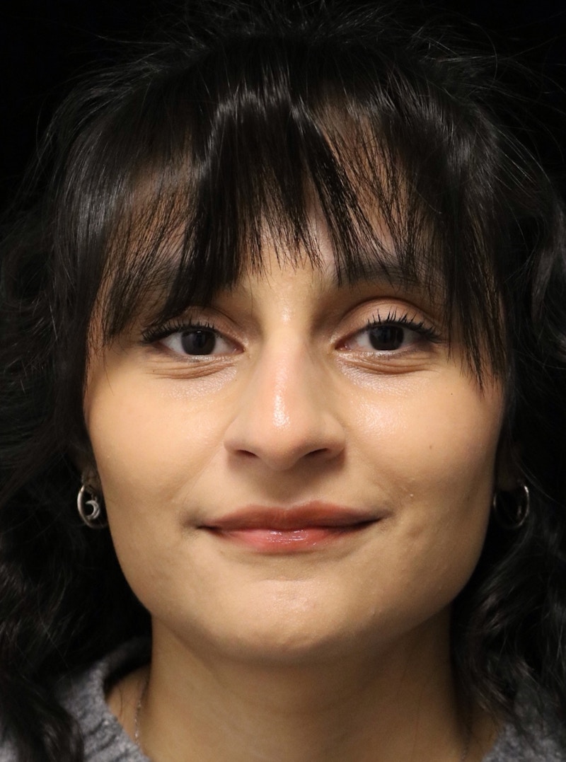 Beverly Hills Rhinoplasty Before & After Gallery - Patient 428554 - Image 5 Dr. Deepak Raj Dugar