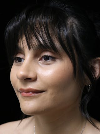 Beverly Hills Rhinoplasty Before & After Gallery - Patient 428554 - Image 10 Dr. Deepak Raj Dugar