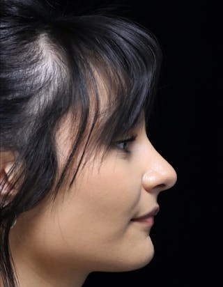 Beverly Hills Rhinoplasty Before & After Gallery - Patient 428554 - Image 2 Dr. Deepak Raj Dugar