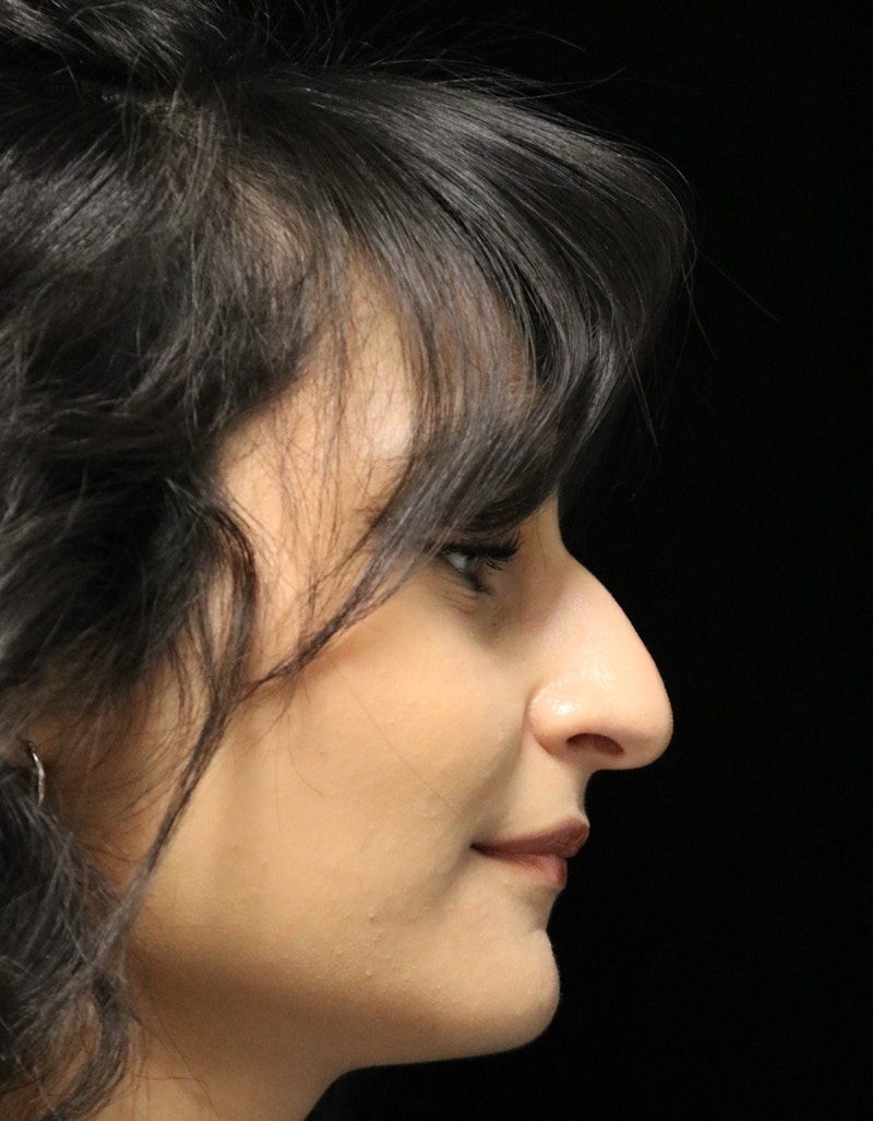 Beverly Hills Rhinoplasty Before & After Gallery - Patient 428554 - Image 1 Dr. Deepak Raj Dugar