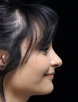 Beverly Hills Rhinoplasty Before & After Gallery - Patient 428554 - Image 4 Dr. Deepak Raj Dugar