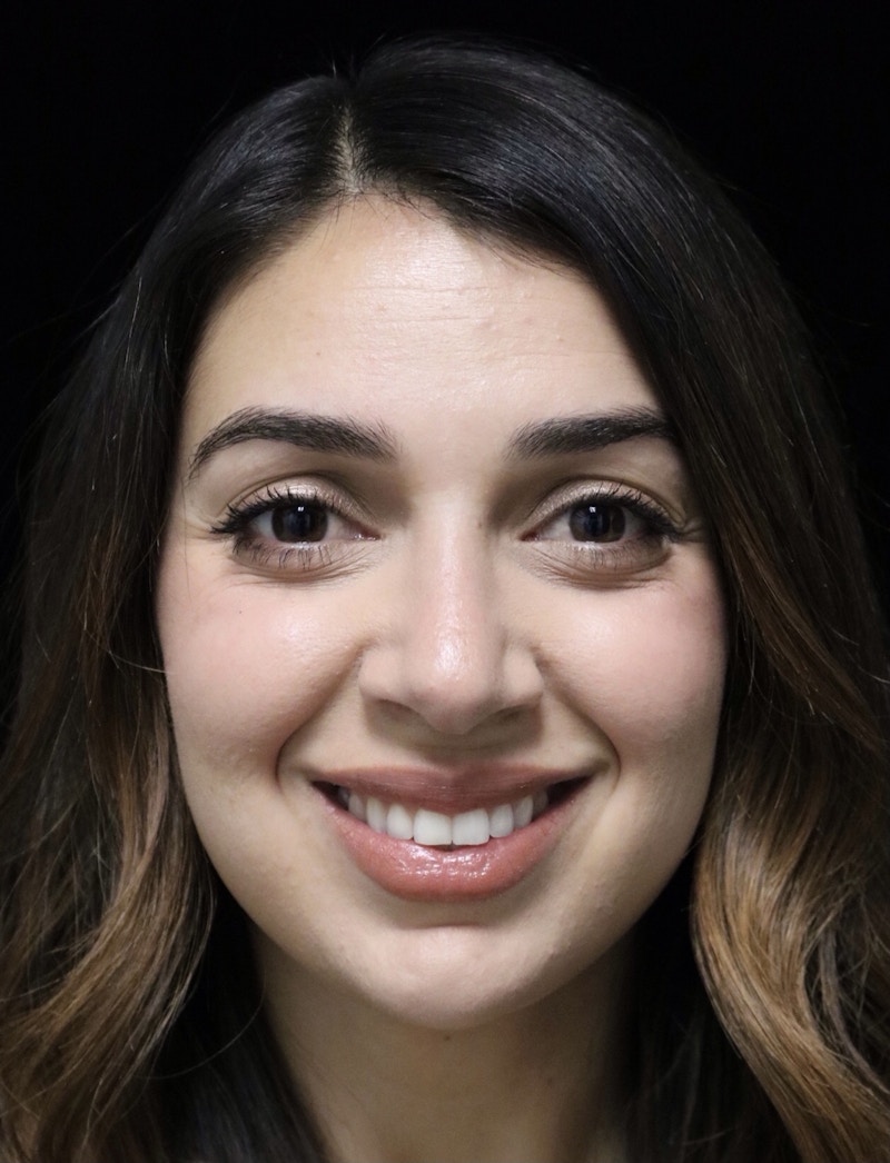 Beverly Hills Rhinoplasty Before & After Gallery - Patient 294599 - Image 8 Dr. Deepak Raj Dugar