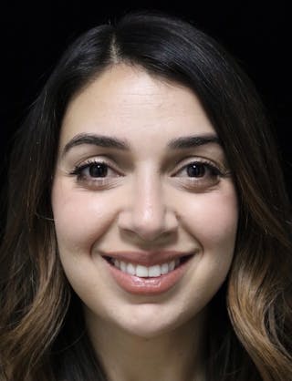 Beverly Hills Rhinoplasty Before & After Gallery - Patient 294599 - Image 8 Dr. Deepak Raj Dugar