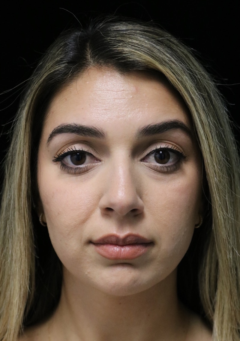 Beverly Hills Rhinoplasty Before & After Gallery - Patient 294599 - Image 5 Dr. Deepak Raj Dugar