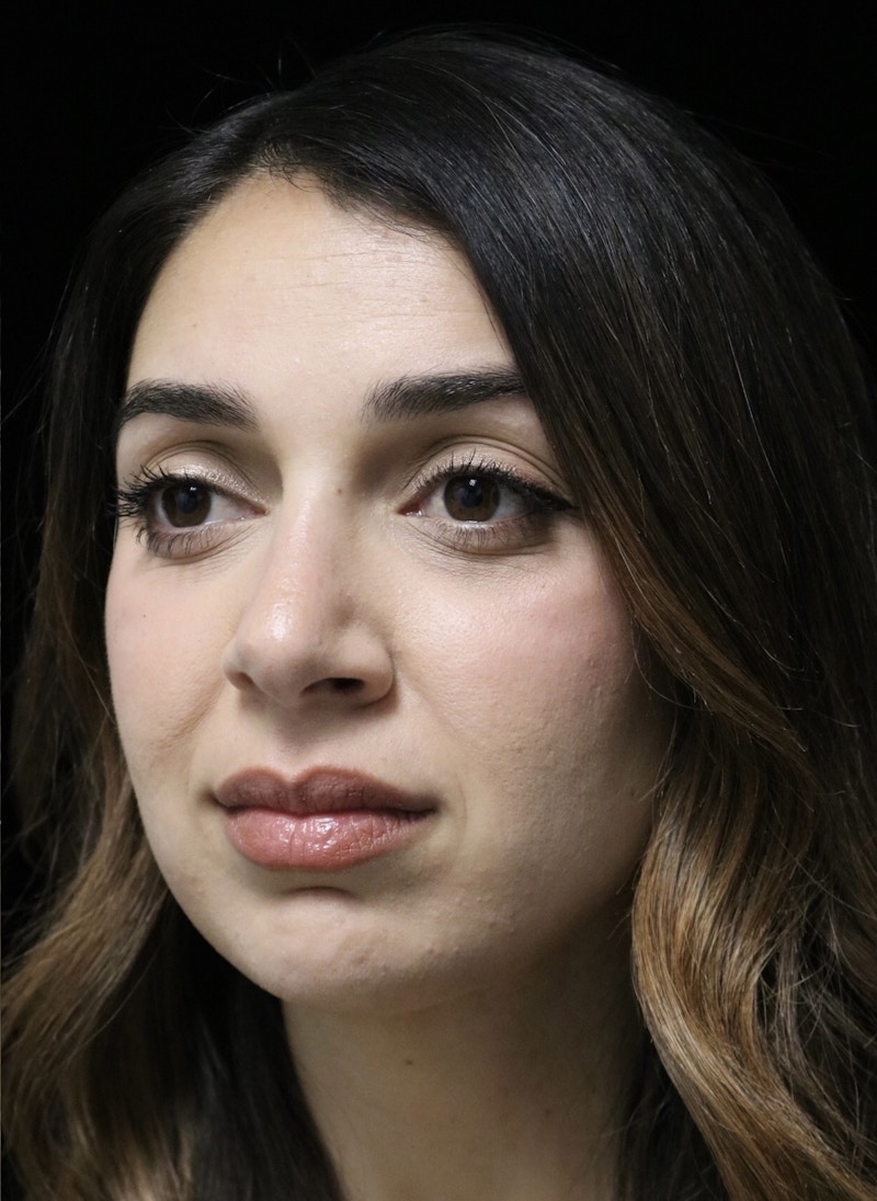 Beverly Hills Rhinoplasty Before & After Gallery - Patient 294599 - Image 10 Dr. Deepak Raj Dugar