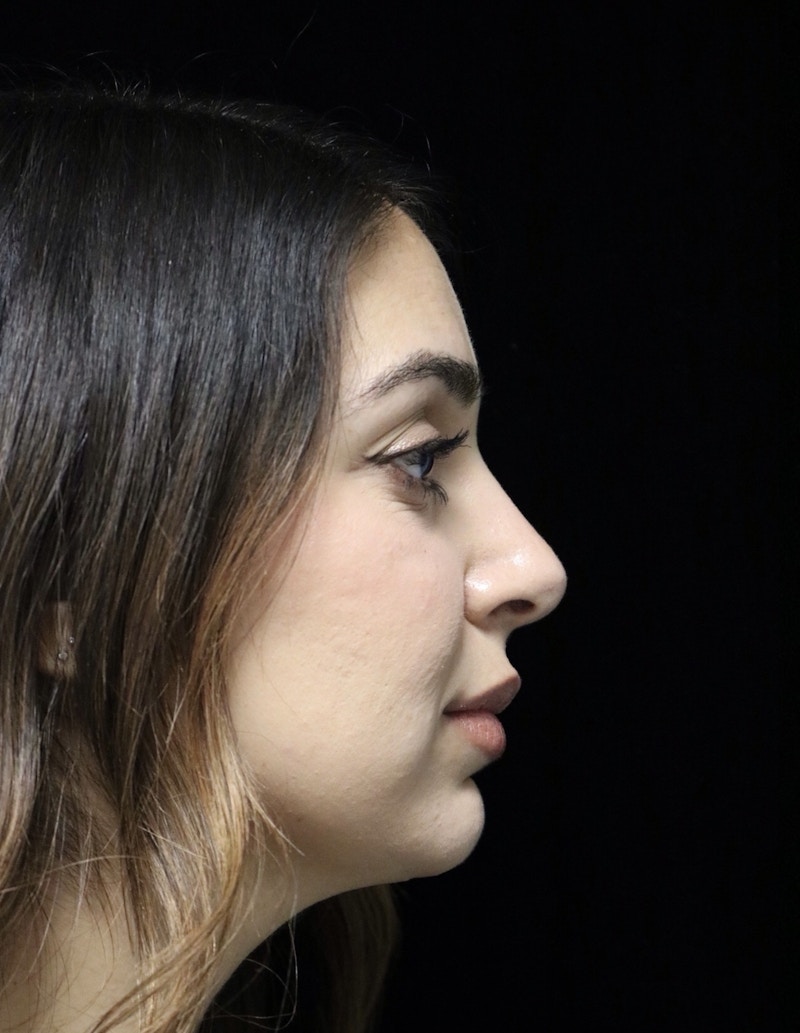 Beverly Hills Rhinoplasty Before & After Gallery - Patient 294599 - Image 2 Dr. Deepak Raj Dugar