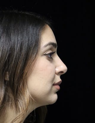 Beverly Hills Rhinoplasty Before & After Gallery - Patient 294599 - Image 2 Dr. Deepak Raj Dugar