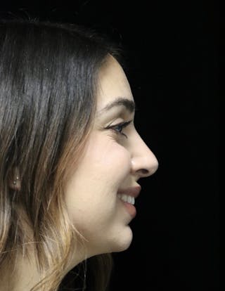 Beverly Hills Rhinoplasty Before & After Gallery - Patient 294599 - Image 4 Dr. Deepak Raj Dugar