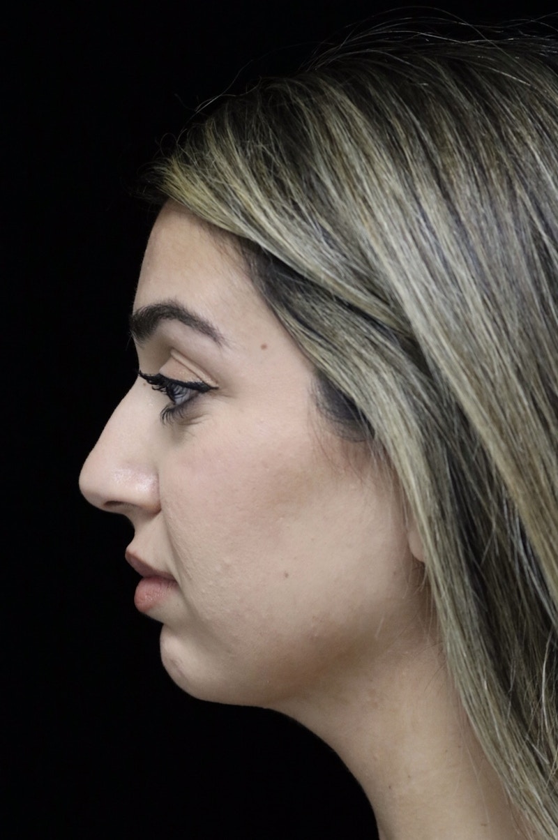 Beverly Hills Rhinoplasty Before & After Gallery - Patient 294599 - Image 11 Dr. Deepak Raj Dugar