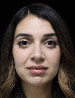 Beverly Hills Rhinoplasty Before & After Gallery - Patient 294599 - Image 6 Dr. Deepak Raj Dugar