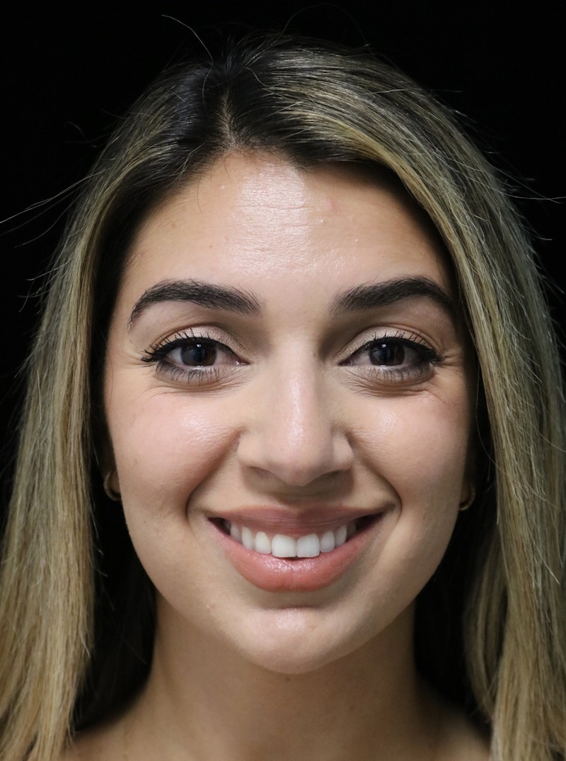 Beverly Hills Rhinoplasty Before & After Gallery - Patient 294599 - Image 7 Dr. Deepak Raj Dugar