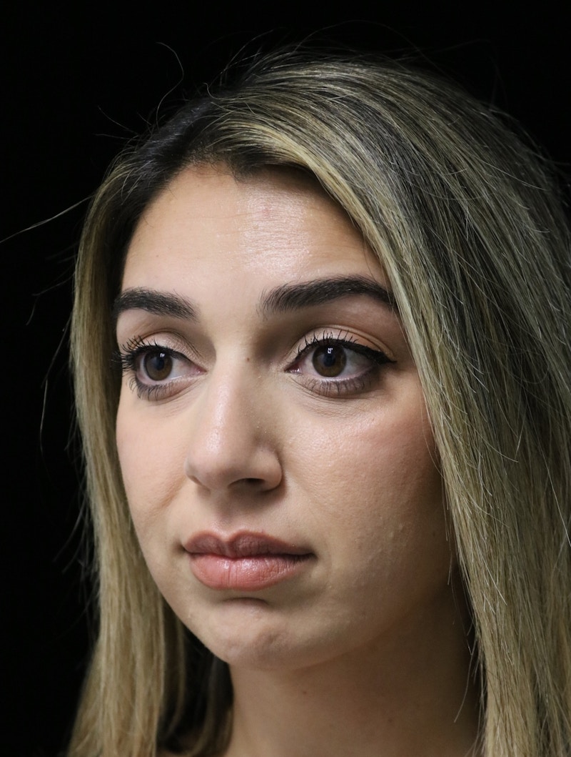 Beverly Hills Rhinoplasty Before & After Gallery - Patient 294599 - Image 9 Dr. Deepak Raj Dugar