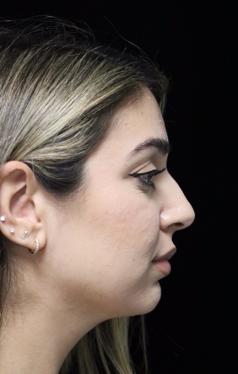 Beverly Hills Rhinoplasty Before & After Gallery - Patient 294599 - Image 1 Dr. Deepak Raj Dugar