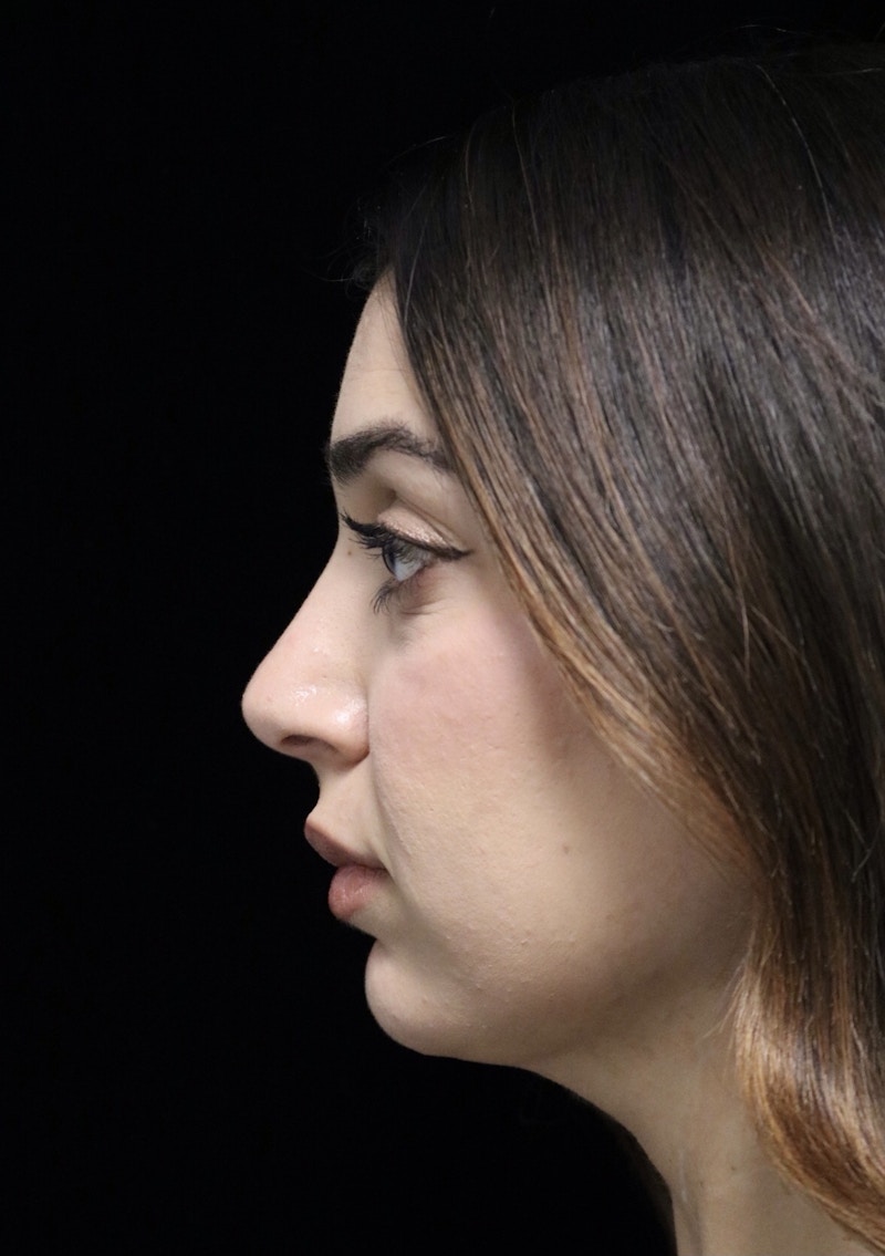 Beverly Hills Rhinoplasty Before & After Gallery - Patient 294599 - Image 12 Dr. Deepak Raj Dugar