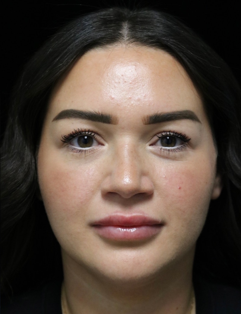 Beverly Hills Rhinoplasty Before & After Gallery - Patient 750619 - Image 5 Dr. Deepak Raj Dugar