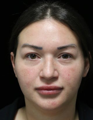 Beverly Hills Rhinoplasty Before & After Gallery - Patient 750619 - Image 6 Dr. Deepak Raj Dugar
