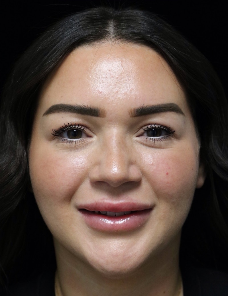 Beverly Hills Rhinoplasty Before & After Gallery - Patient 750619 - Image 7 Dr. Deepak Raj Dugar