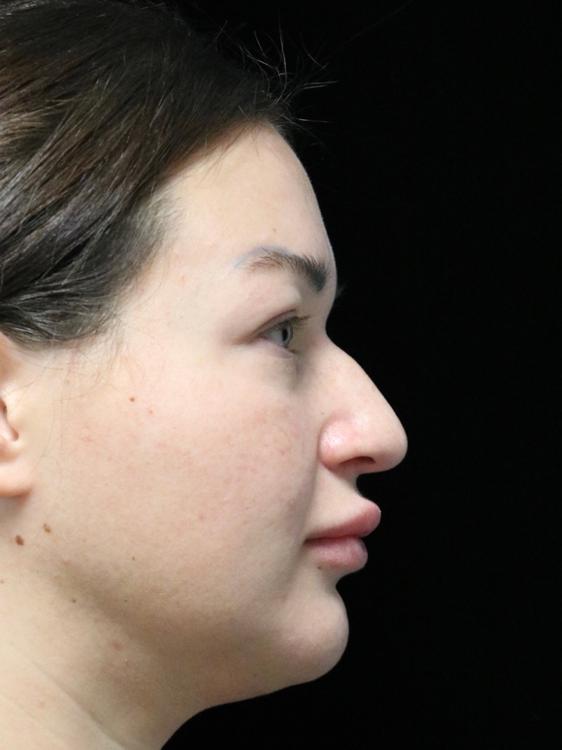 Beverly Hills Rhinoplasty Before & After Gallery - Patient 750619 - Image 1 Dr. Deepak Raj Dugar