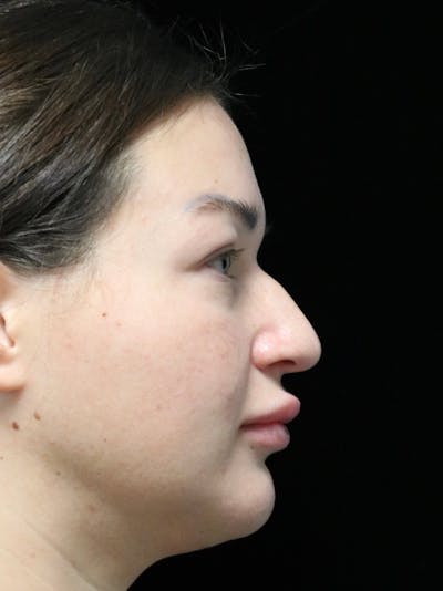 Beverly Hills Rhinoplasty Before & After Gallery - Patient 750619 - Image 1 Dr. Deepak Raj Dugar