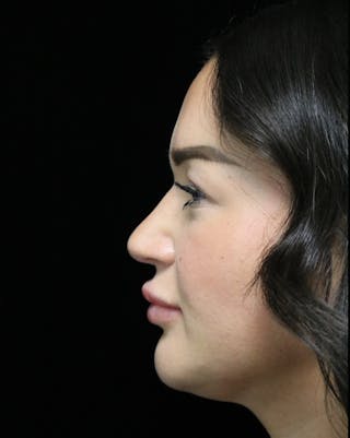 Beverly Hills Rhinoplasty Before & After Gallery - Patient 750619 - Image 12 Dr. Deepak Raj Dugar