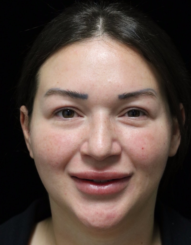 Beverly Hills Rhinoplasty Before & After Gallery - Patient 750619 - Image 8 Dr. Deepak Raj Dugar