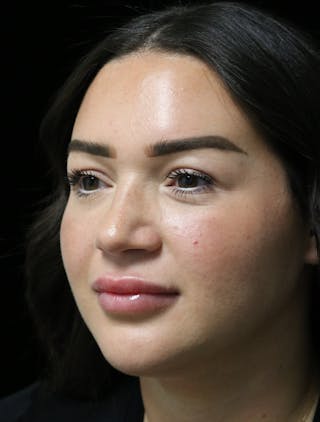 Beverly Hills Rhinoplasty Before & After Gallery - Patient 750619 - Image 10 Dr. Deepak Raj Dugar