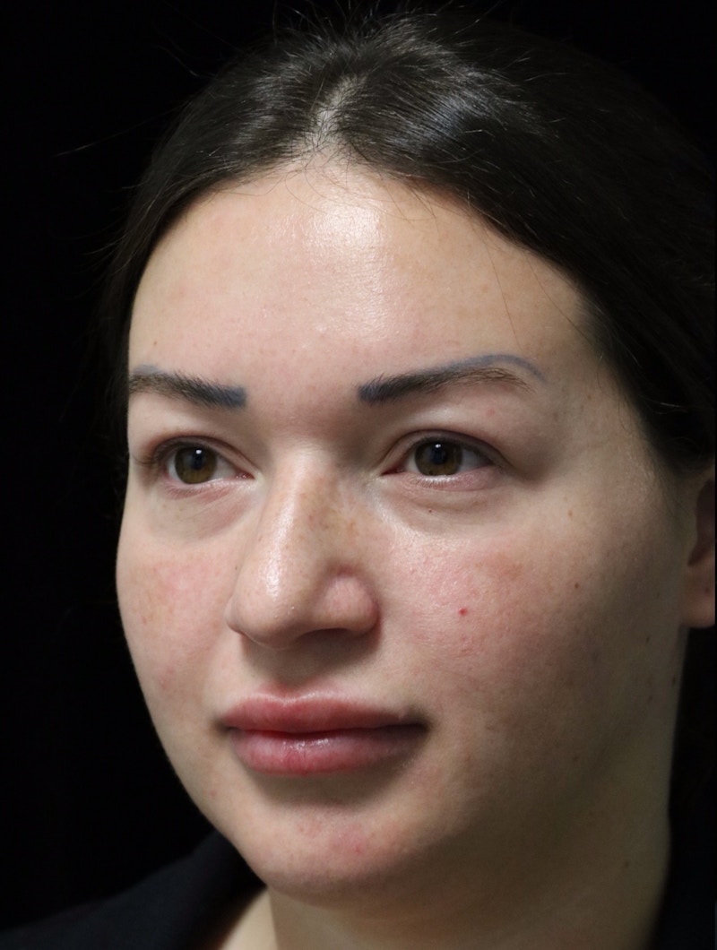 Beverly Hills Rhinoplasty Before & After Gallery - Patient 750619 - Image 9 Dr. Deepak Raj Dugar