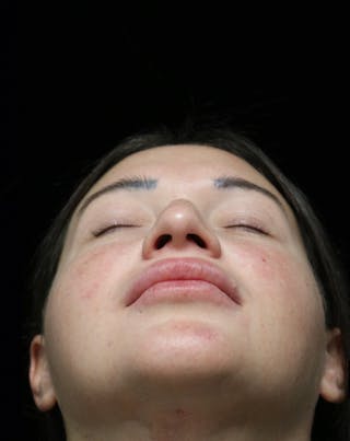 Beverly Hills Rhinoplasty Before & After Gallery - Patient 750619 - Image 14 Dr. Deepak Raj Dugar