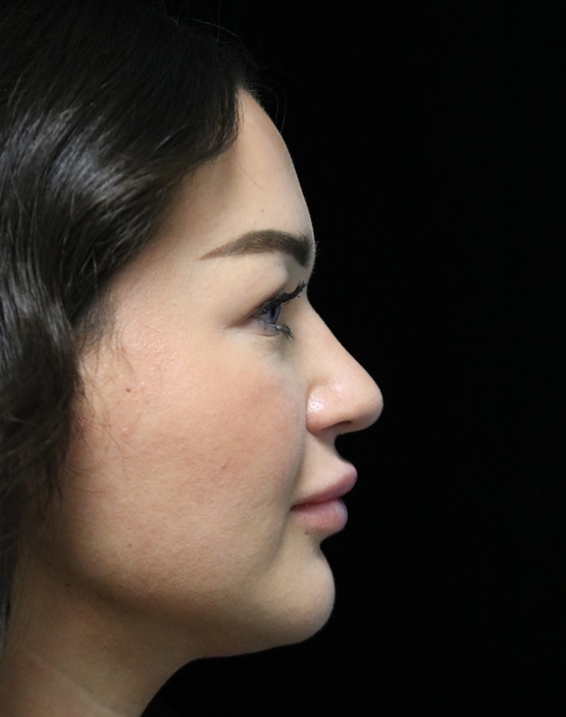 Beverly Hills Rhinoplasty Before & After Gallery - Patient 750619 - Image 2 Dr. Deepak Raj Dugar