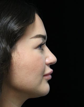 Beverly Hills Rhinoplasty Before & After Gallery - Patient 750619 - Image 2 Dr. Deepak Raj Dugar