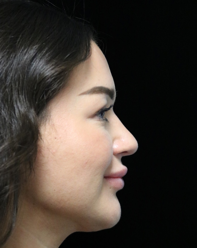 Beverly Hills Rhinoplasty Before & After Gallery - Patient 750619 - Image 4 Dr. Deepak Raj Dugar