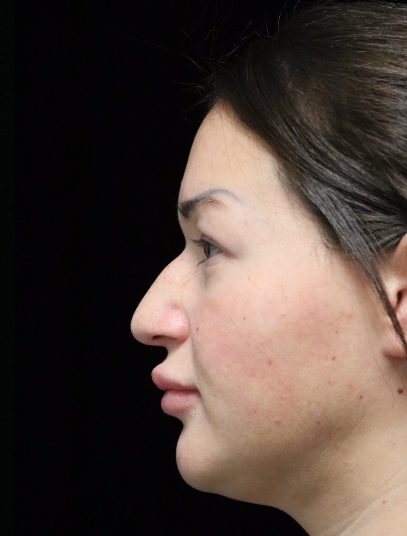 Beverly Hills Rhinoplasty Before & After Gallery - Patient 750619 - Image 11 Dr. Deepak Raj Dugar
