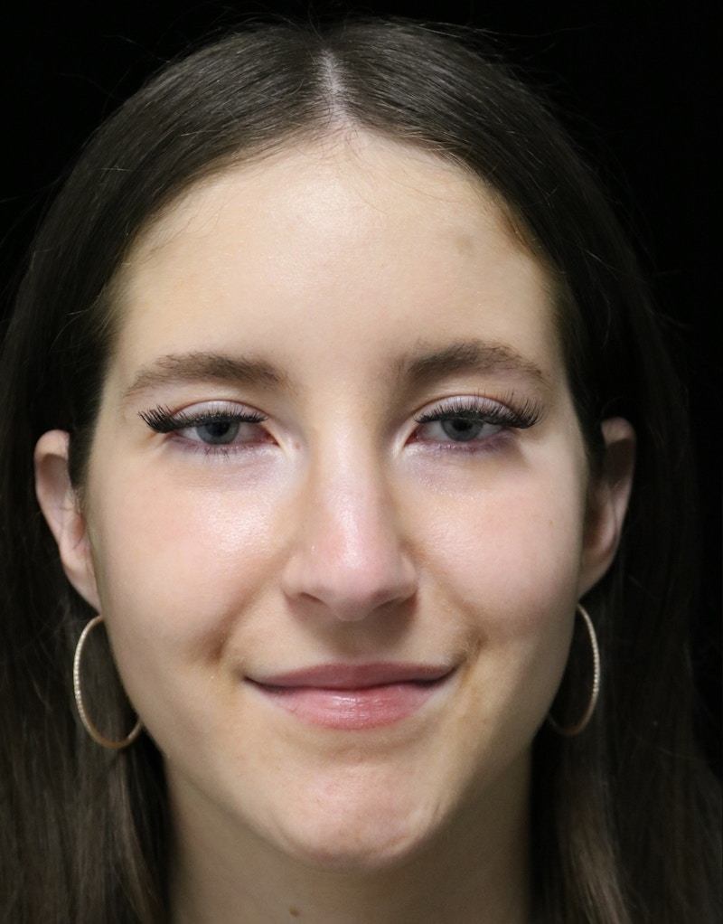 Beverly Hills Rhinoplasty Before & After Gallery - Patient 411847 - Image 7 Dr. Deepak Raj Dugar