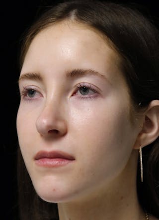 Beverly Hills Rhinoplasty Before & After Gallery - Patient 411847 - Image 10 Dr. Deepak Raj Dugar