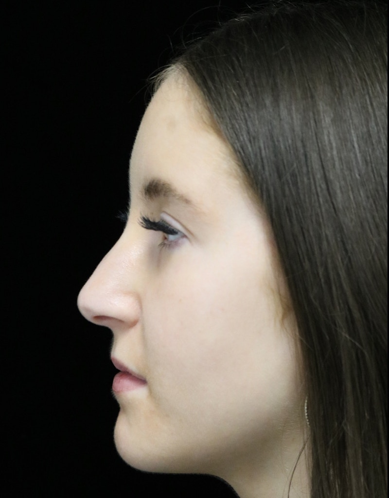 Beverly Hills Rhinoplasty Before & After Gallery - Patient 411847 - Image 11 Dr. Deepak Raj Dugar