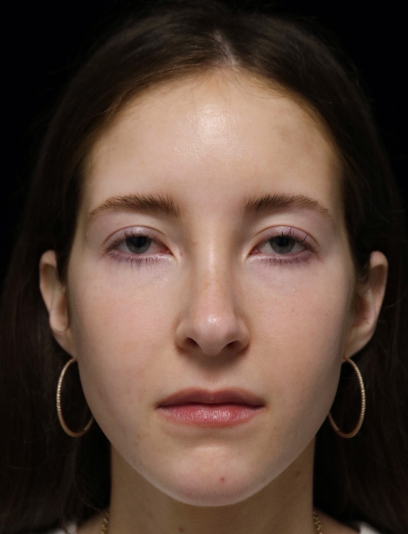 Beverly Hills Rhinoplasty Before & After Gallery - Patient 411847 - Image 6 Dr. Deepak Raj Dugar