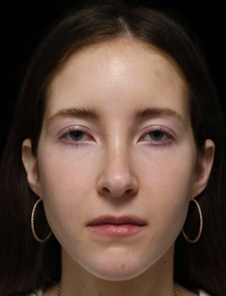 Beverly Hills Rhinoplasty Before & After Gallery - Patient 411847 - Image 6 Dr. Deepak Raj Dugar