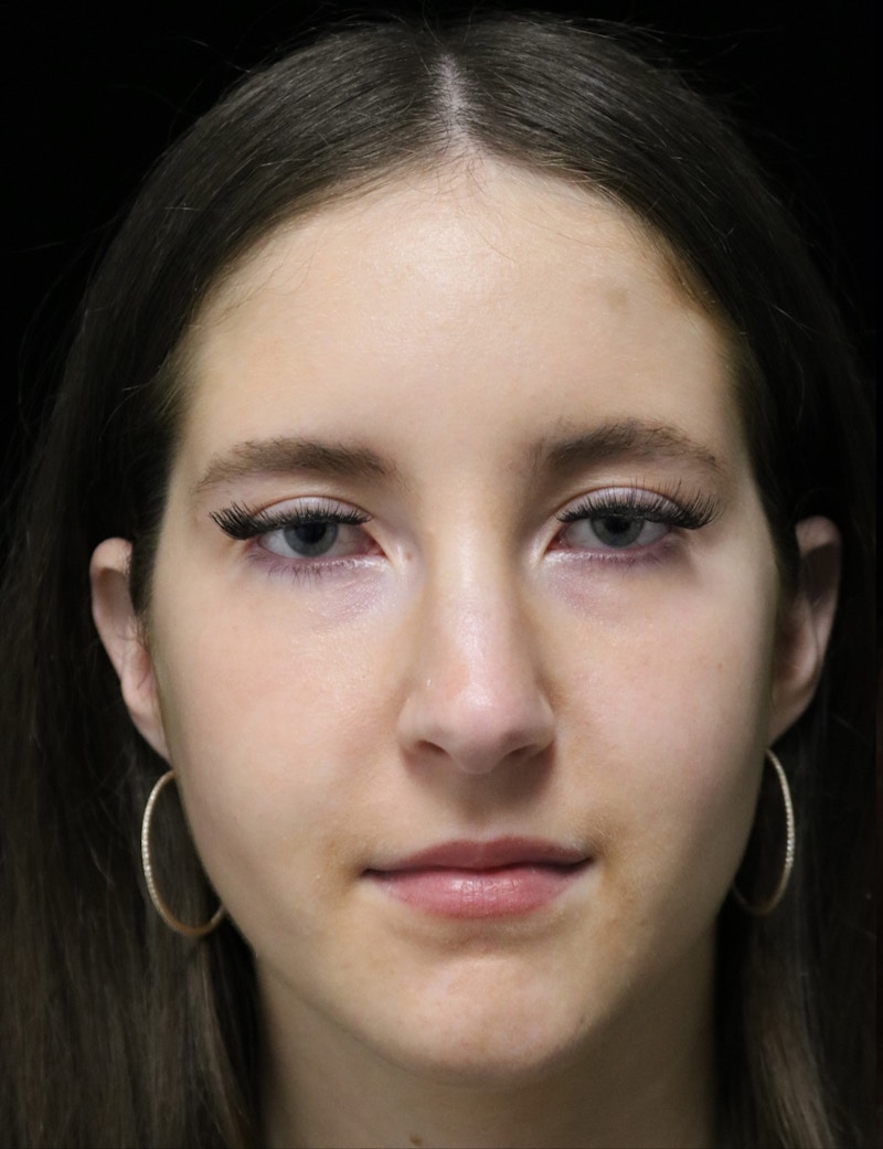 Beverly Hills Rhinoplasty Before & After Gallery - Patient 411847 - Image 5 Dr. Deepak Raj Dugar