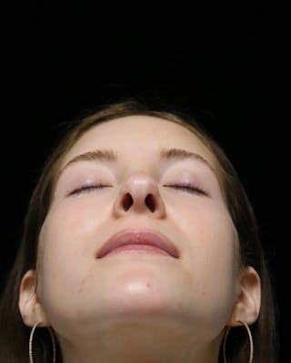 Beverly Hills Rhinoplasty Before & After Gallery - Patient 411847 - Image 14 Dr. Deepak Raj Dugar