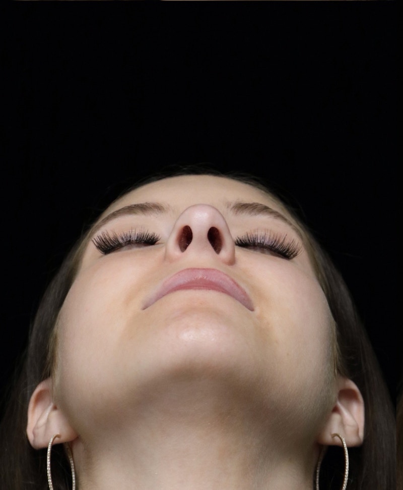 Beverly Hills Rhinoplasty Before & After Gallery - Patient 411847 - Image 13 Dr. Deepak Raj Dugar