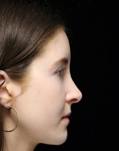 Beverly Hills Rhinoplasty Before & After Gallery - Patient 411847 - Image 2 Dr. Deepak Raj Dugar