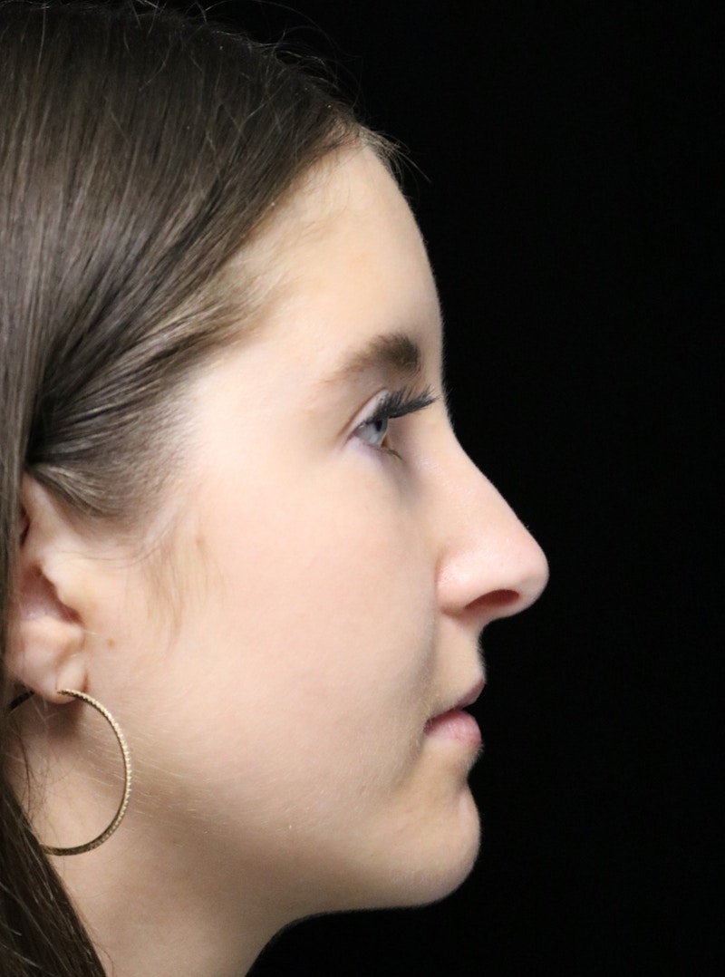 Beverly Hills Rhinoplasty Before & After Gallery - Patient 411847 - Image 1 Dr. Deepak Raj Dugar