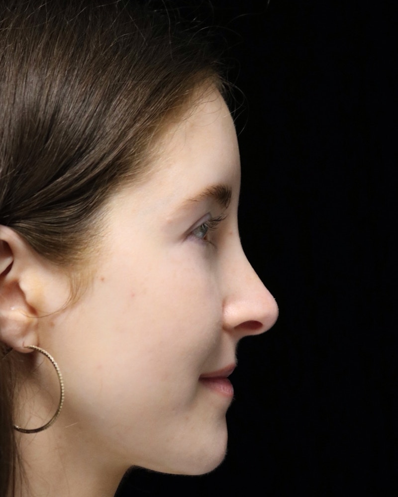 Beverly Hills Rhinoplasty Before & After Gallery - Patient 411847 - Image 4 Dr. Deepak Raj Dugar