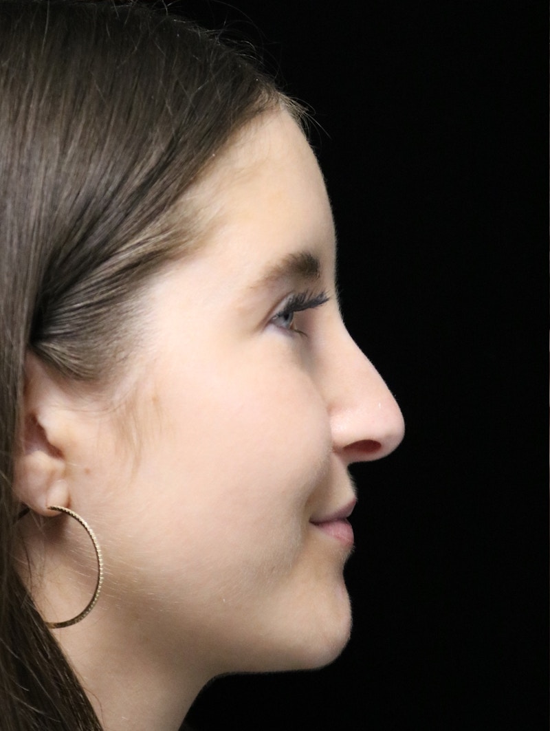 Beverly Hills Rhinoplasty Before & After Gallery - Patient 411847 - Image 3 Dr. Deepak Raj Dugar