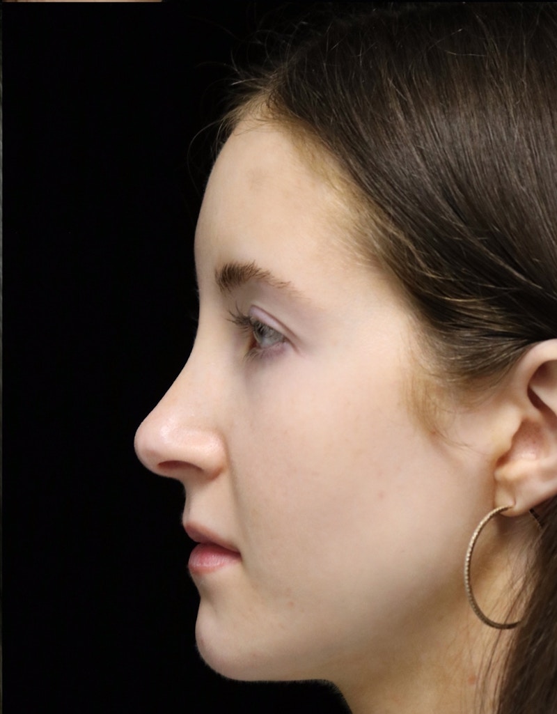 Beverly Hills Rhinoplasty Before & After Gallery - Patient 411847 - Image 12 Dr. Deepak Raj Dugar